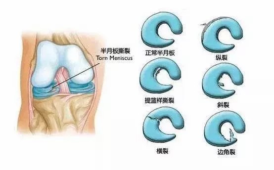 半月板到底是個什么“板”？-昭通李景鏵中醫(yī)骨傷醫(yī)院