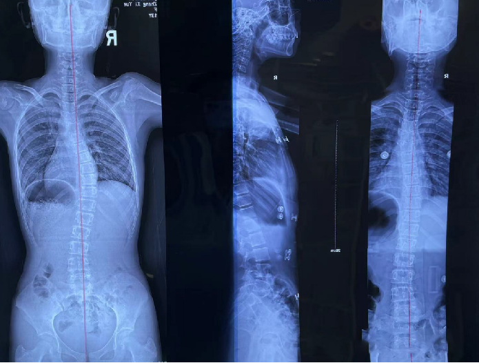 青少年脊柱側(cè)彎 昭通李景鏵醫(yī)院有“神器”-昭通李景鏵中醫(yī)骨傷醫(yī)院