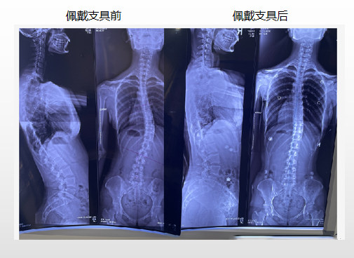 青少年脊柱側(cè)彎 昭通李景鏵醫(yī)院有“神器”-昭通李景鏵中醫(yī)骨傷醫(yī)院